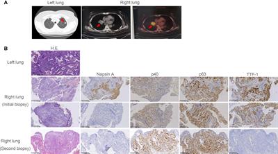 Case Report: Dramatic Response to Crizotinib in a Patient With Non-Small Cell Lung Cancer Positive for a Novel ARL1-MET Fusion